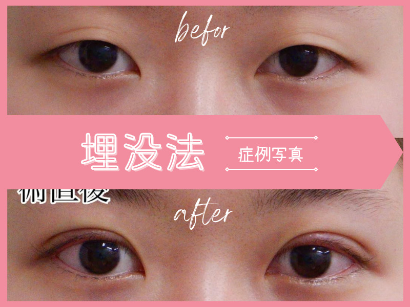 埋没法：二重埋没法