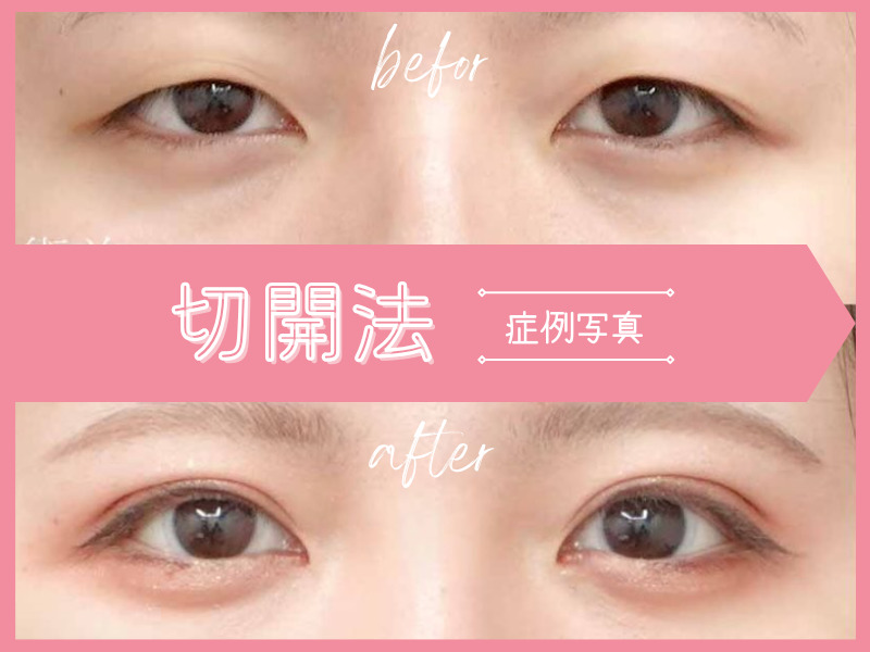 切開法：二重術切開法