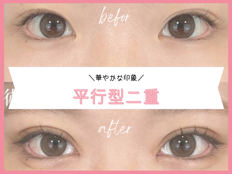 平行型：華やかな仕上がり