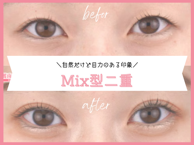 Mix型：自然にぱっちりとした仕上がり